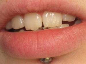 Chipped tooth from metal piercing